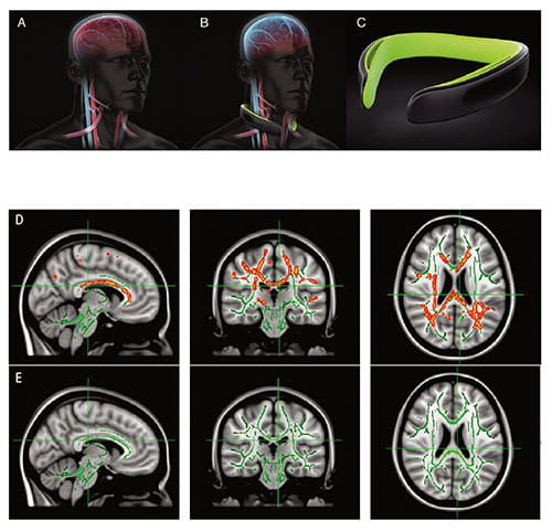 Fig A:  Diffusion tensor imaging shows how sports collisions can affect the brain’s white matter. A: Illustrates normal blood flow. B: Illustrates blood volume changes with Q-Collar. C: The Q-Collar. D: Marked areas show increases in mean diffusivity. E: Marked areas in this row show increases in radial diffusivity.  